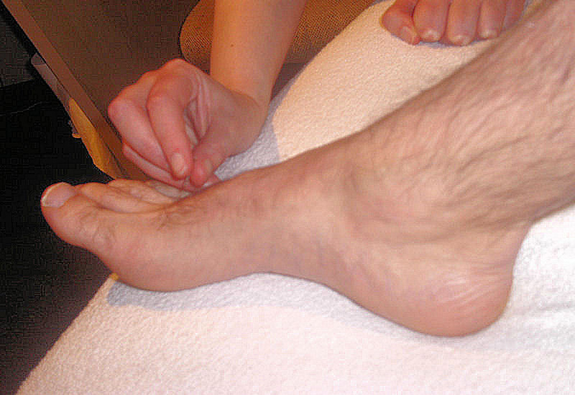 Acupuncture treatment detail around foot and ankle