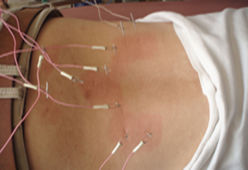 Electroacupuncture treatment detail